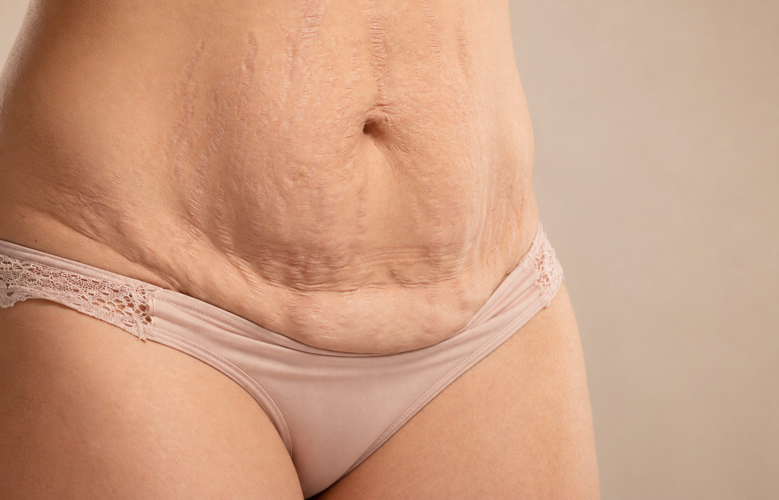 O posegu abdominoplastika