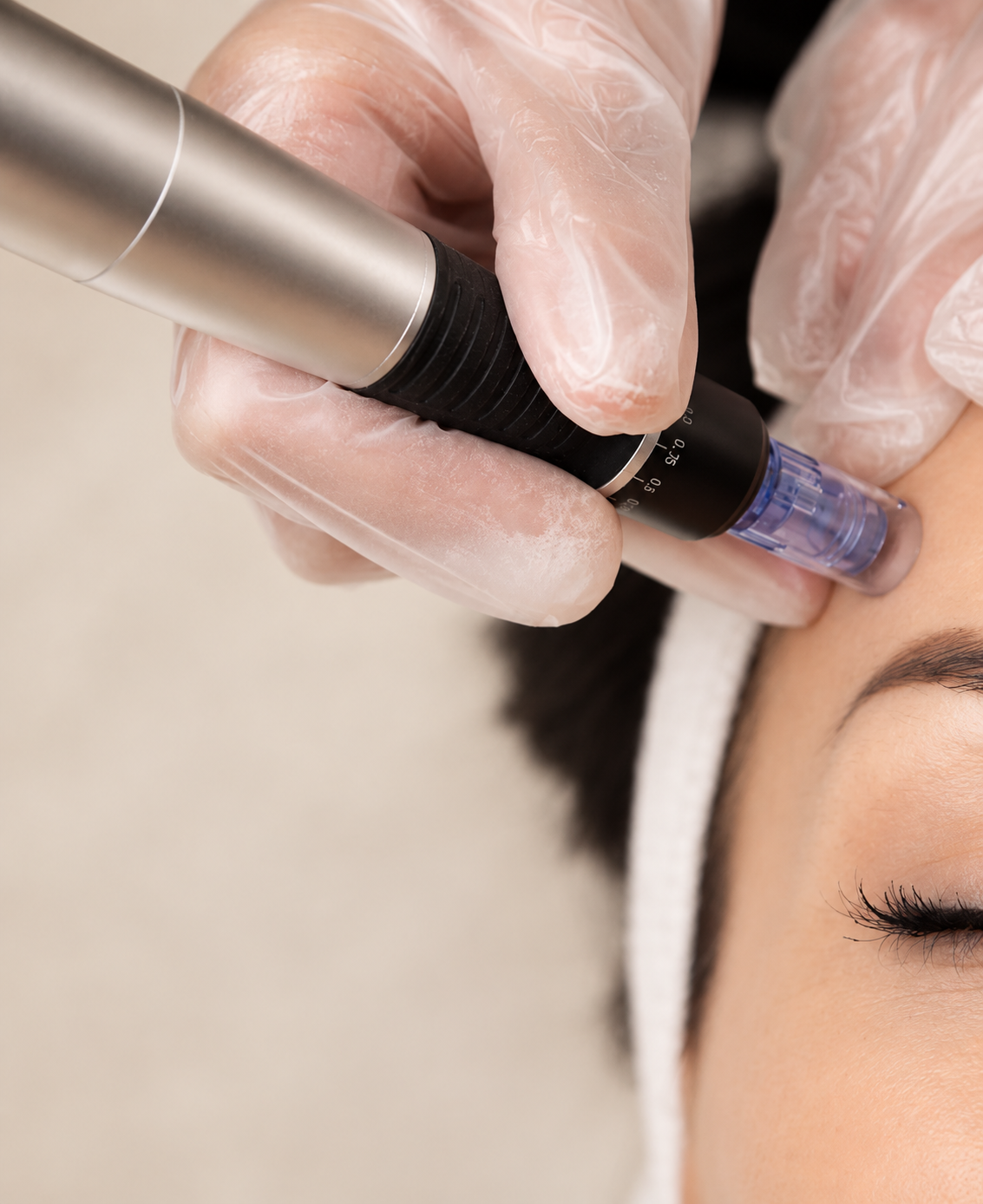 O terapiji microneedling