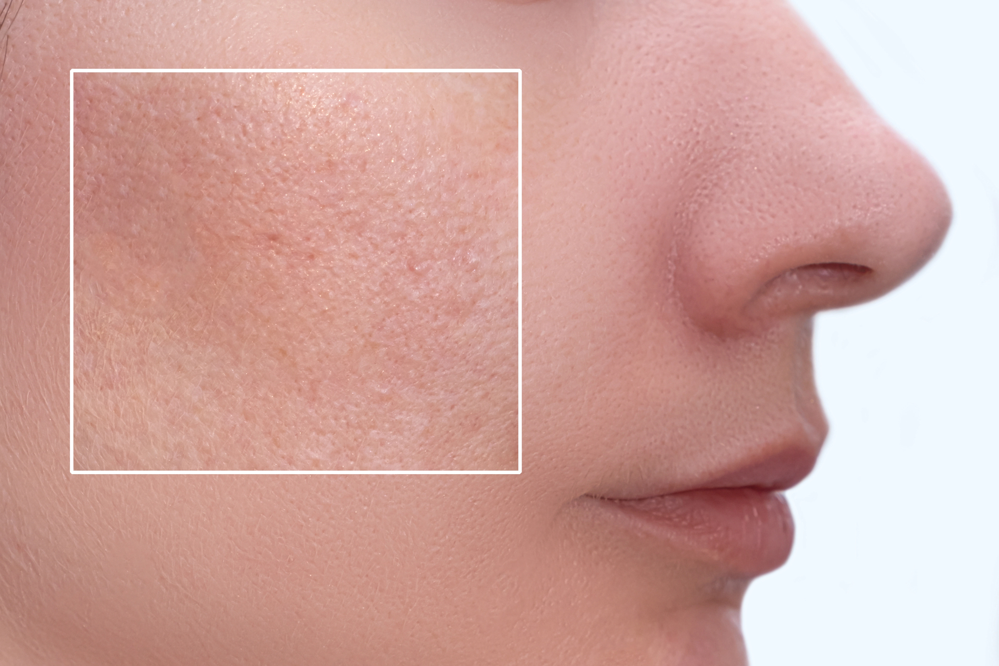 O terapiji microneedling